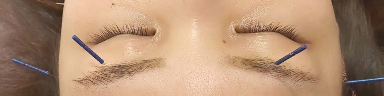 KAILAokinawaで美容鍼を受けている女性